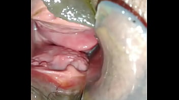 Buceta Arrombada Do Jeito Que Gosto. Prolapso Vaginal