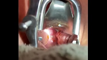 Inserting Foley Into Cervix