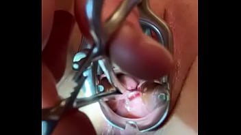 Sound Tenaculum Applying Traction To Cervix