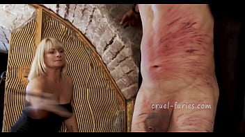 Painful Red Bruises On Poor Guy’ Flesh